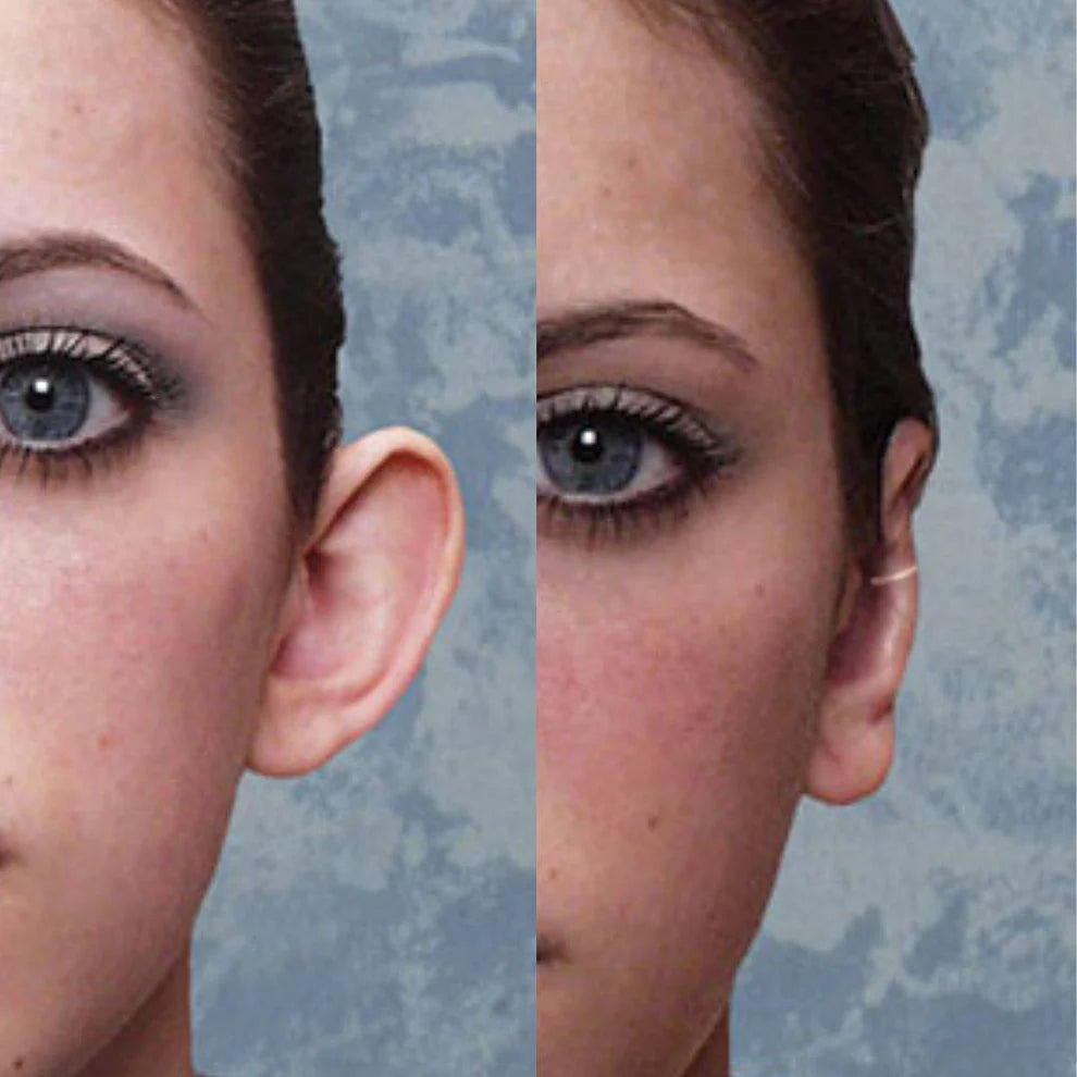 🔥 SET Corectoo – Clemă corectoare pentru urechi